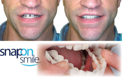Carillas Dentales snap on