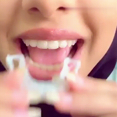 Carillas Dentales snap on