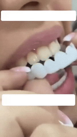 Carillas Dentales snap on